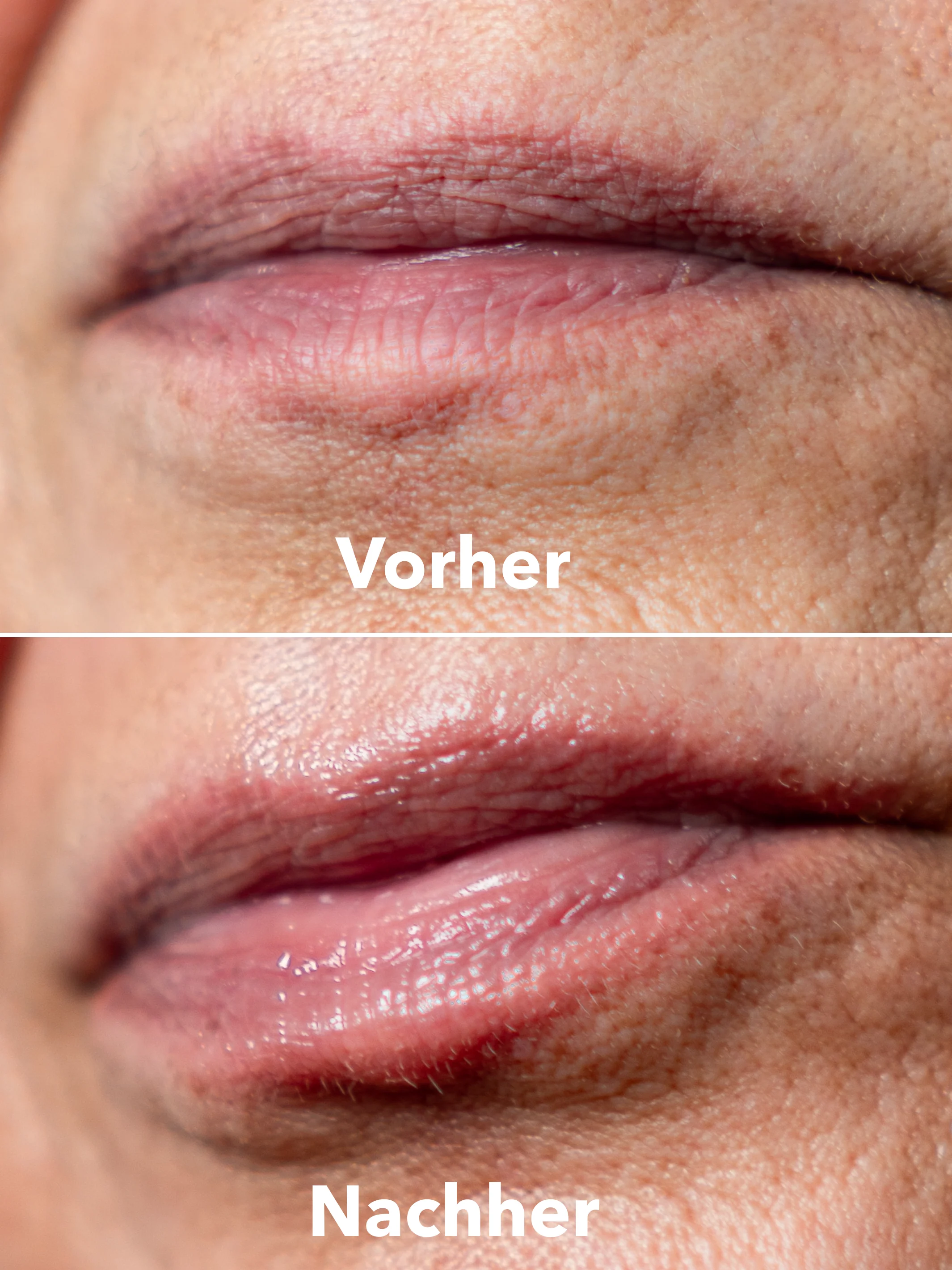 XTREME Lip Recovery - Image 3