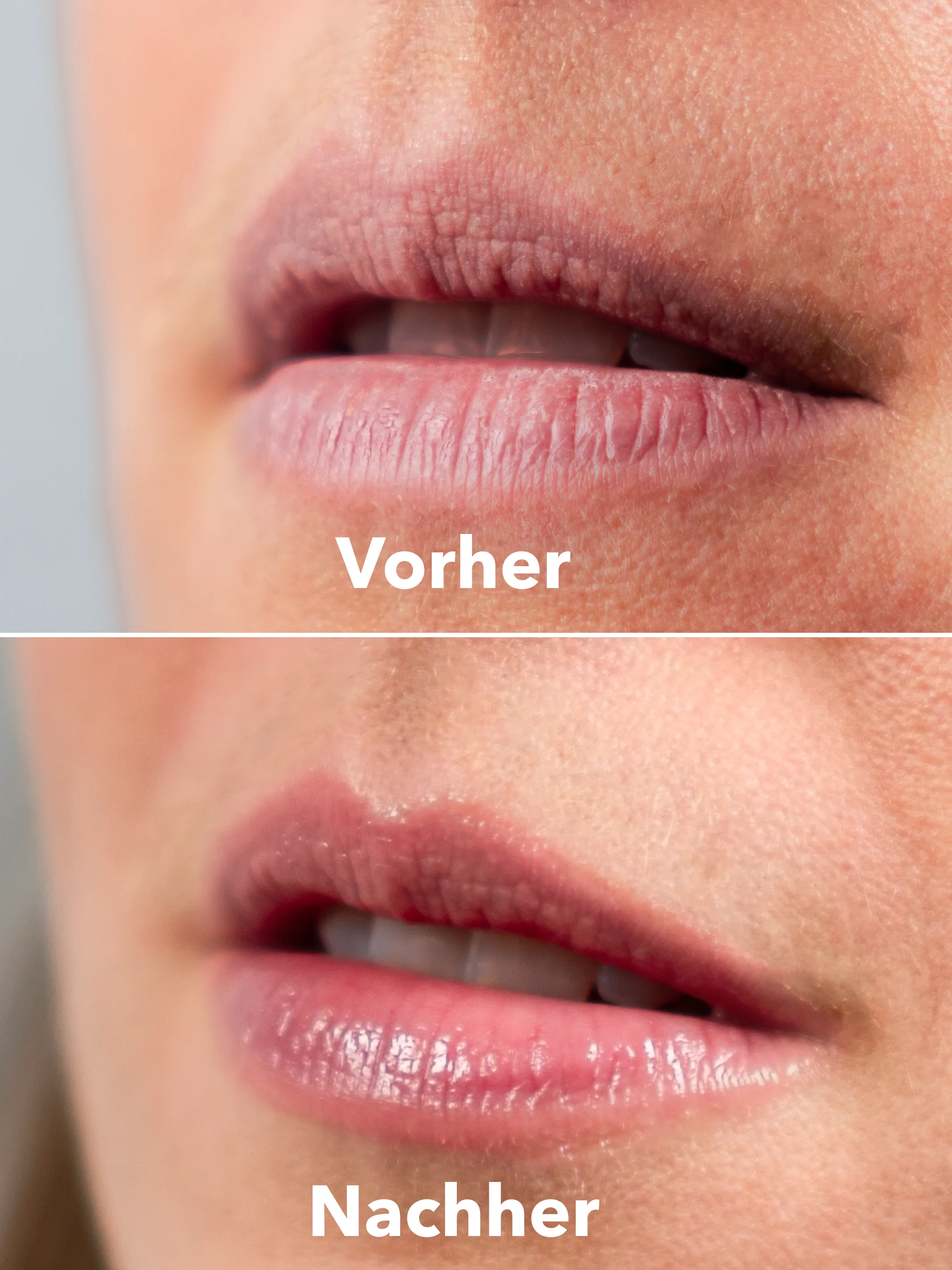 XTREME Lip Recovery - Image 4